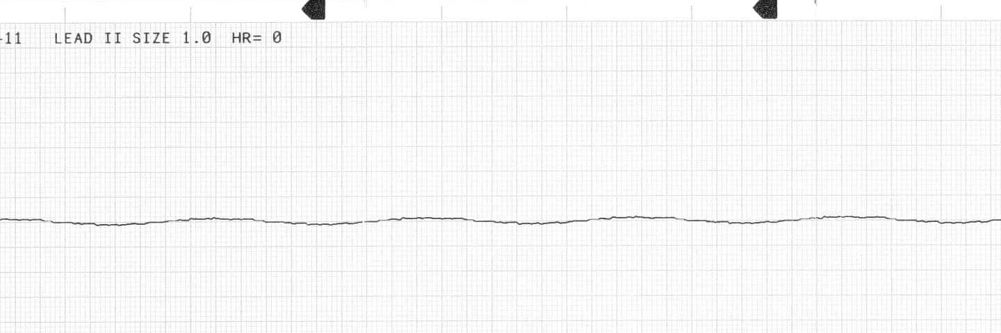 Asystole - nil electrical activity - ALS Now