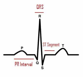 ECG Pattern - ALS Now